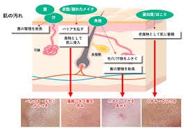 images - 2026-09-17T010347104 - SomethingBeautiful!! Cross-section diagram of skin with a hair follicle and sebaceous gland, with labeled arrows and four magnified skin lesion photos beneath.